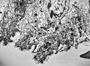 M,7y. | epidermolysis bullosa (dystrophic type) - oral mucosa M,7y. | epidermolysis bullosa (dystrophic type) - oral mucosa